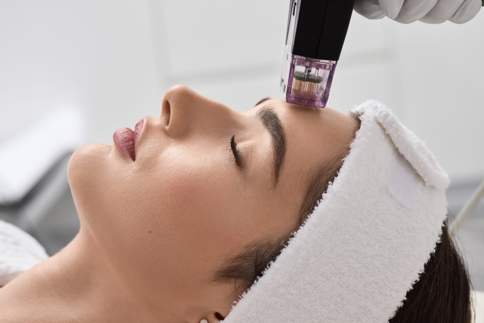 Where to Get RF Microneedling in Montreal: What to Look For
